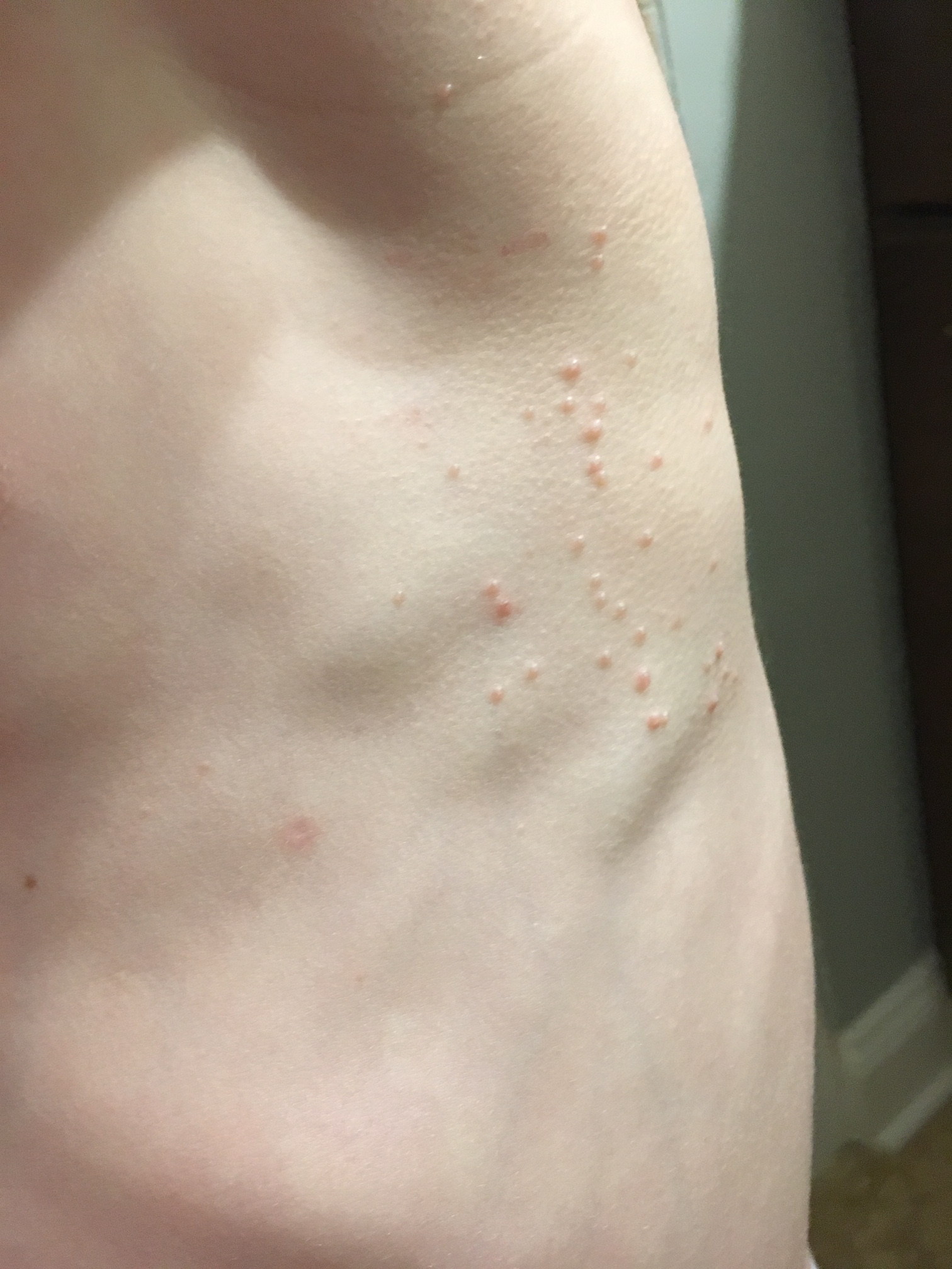 Shorts Molluscum Contagiosum What Are These Bumps On My Kid – NBKomputer