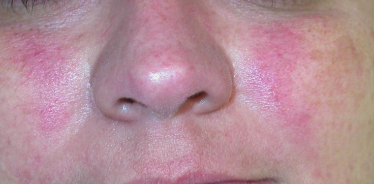 Top 5 Triggers of Rosacea to Avoid