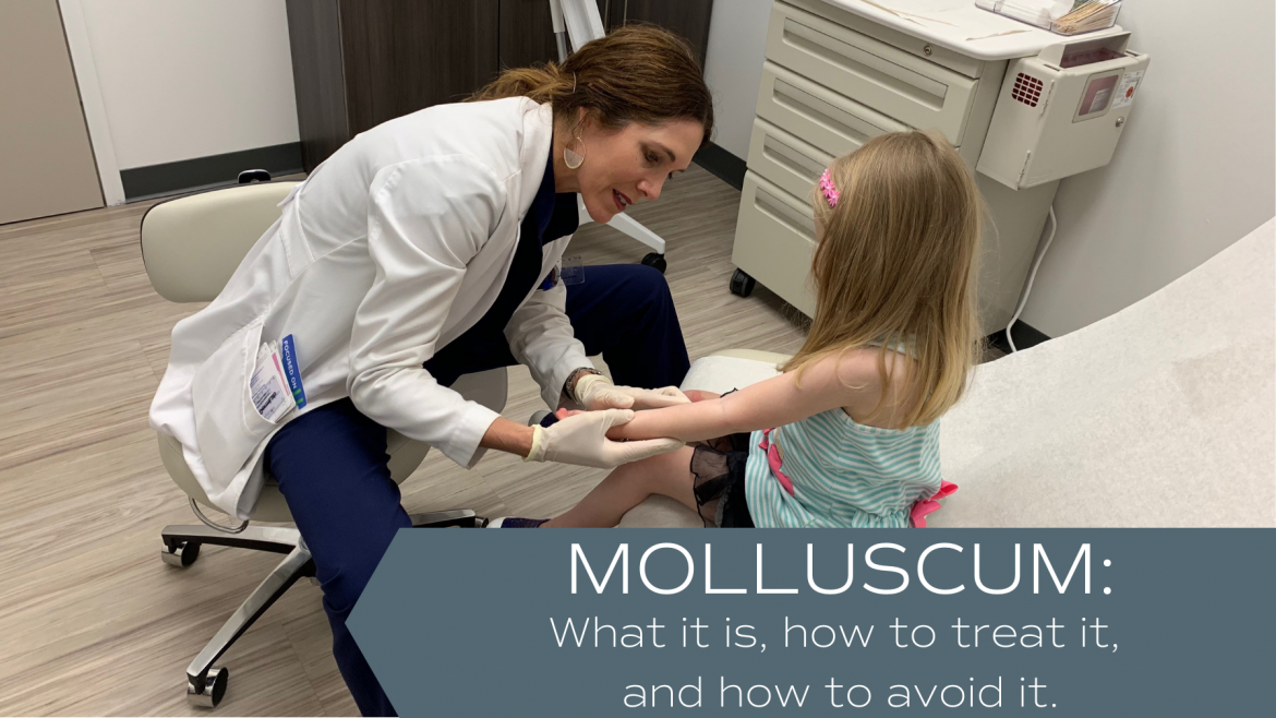 Molluscum:  What is it, how to treat it, how to avoid it.