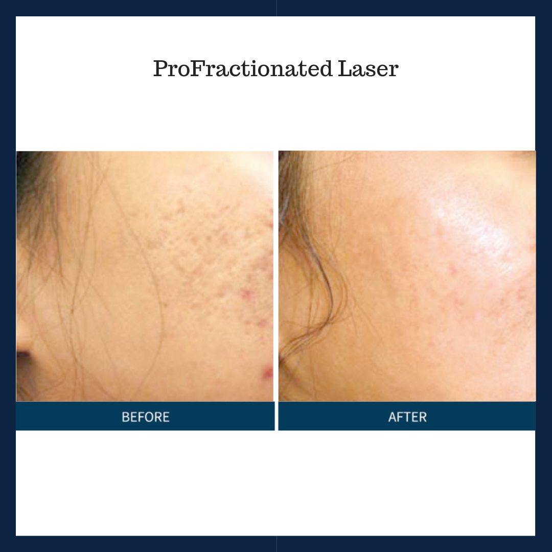 Resurfacing Lasers and Microneedling: Fractionated Smoothing - Renew ...