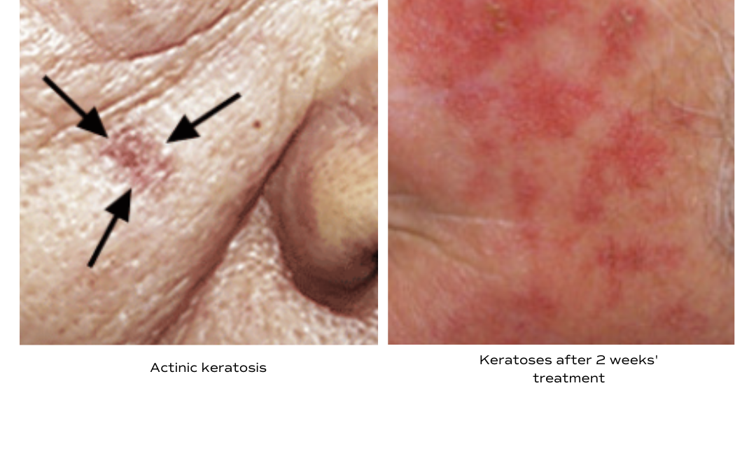 Treatment Options for Actinic Keratosis