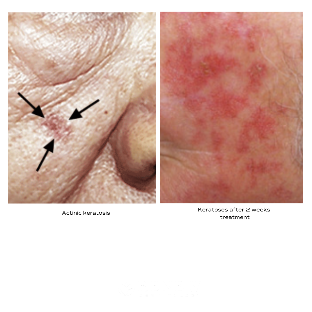 Treatment Options For Actinic Keratosis Renew Dermatology