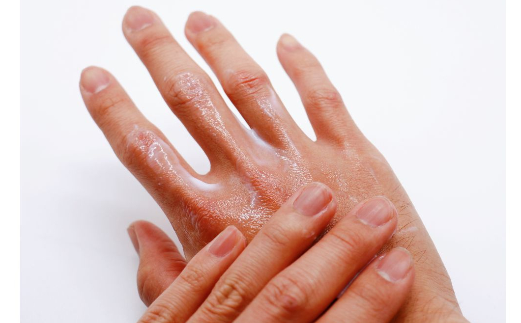 Preventing and Treating Dry, Cracked Hands