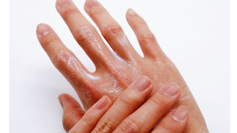 Preventing and Treating Dry, Cracked Hands