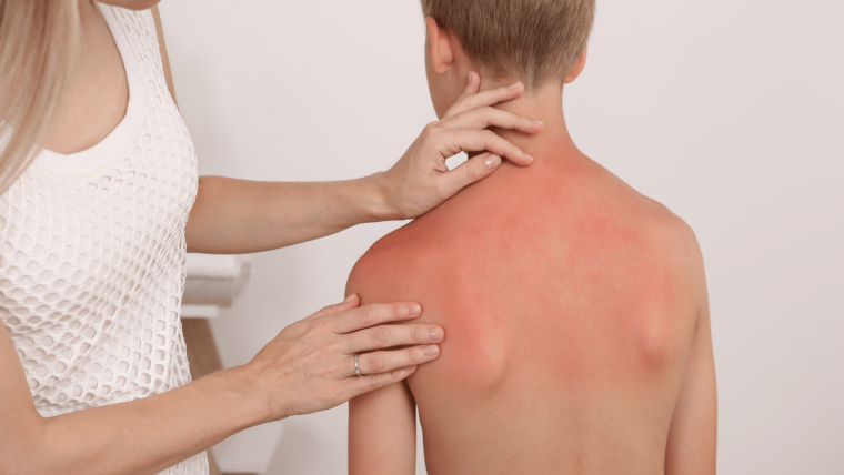 Post-Sun Recovery Tips for Healthy, Radiant Skin